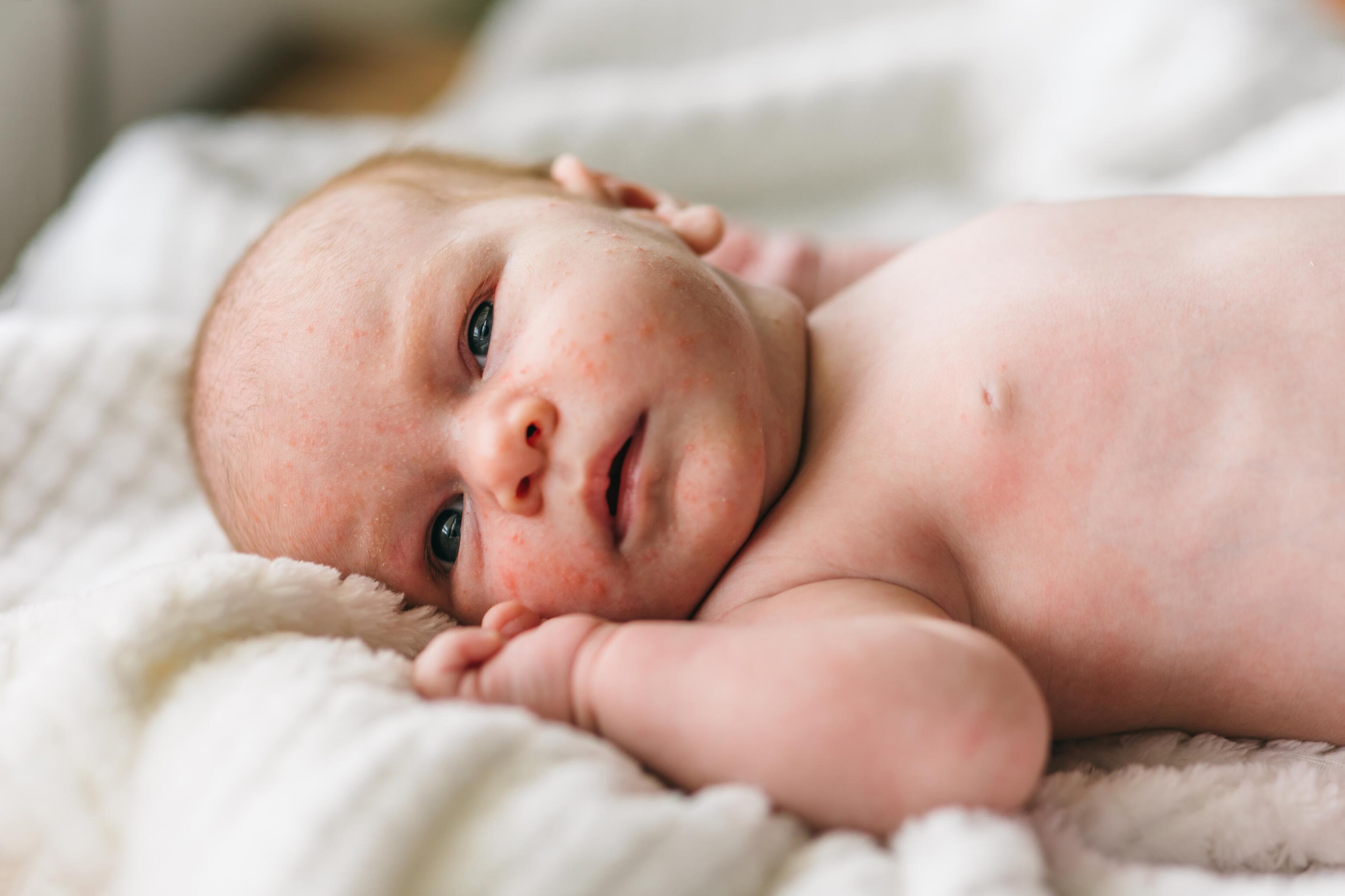 Acne bij pasgeborenen (baby's)